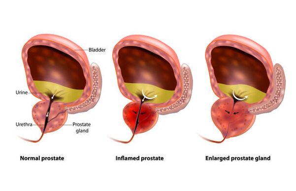 前列腺炎是前列腺的炎症