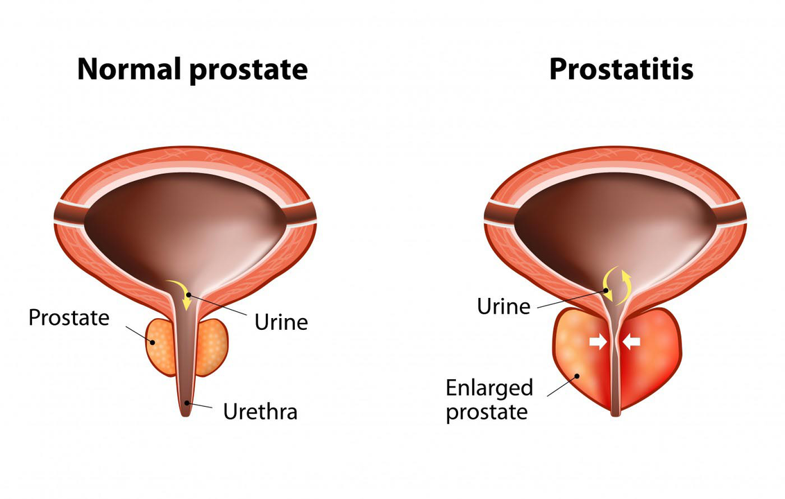 健康男性的正常前列腺和患有前列腺炎的前列腺炎症
